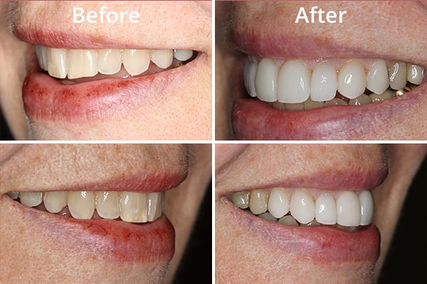 Close-up of before and after a patient's cosmetic treatment
