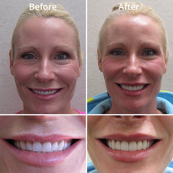 An example of the impact of cosmetic dentistry on a patient's smile