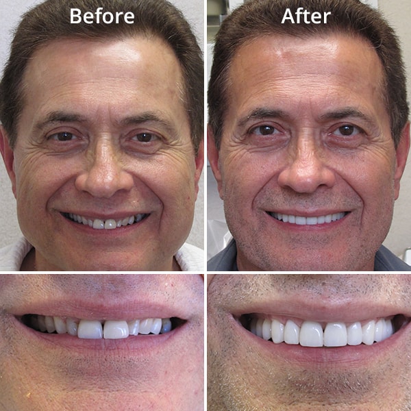 Before and after shots of our cosmetic dentistry patient