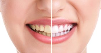 Woman's smile before teeth whitening on the left and after teeth whitening on the right