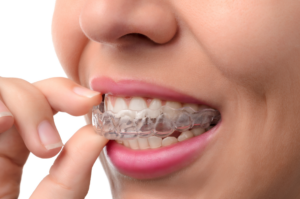 Clear aligners are placed onto upper teeth.